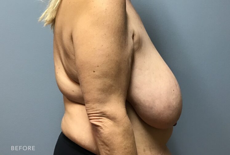 A photo of a woman's body shows disproportionately large breasts compared to the rest of her body, affecting posture and balance. | Albany, Latham, Saratoga NY, Plastic Surgery