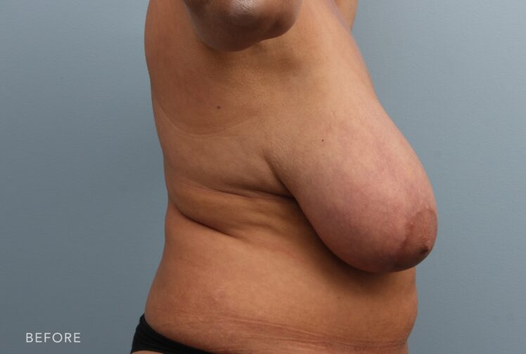 A photo of a woman's body shows breasts that are significantly larger than what is proportionate to her body, causing discomfort or difficulty with physical activities. | Albany, Latham, Saratoga NY, Plastic Surgery