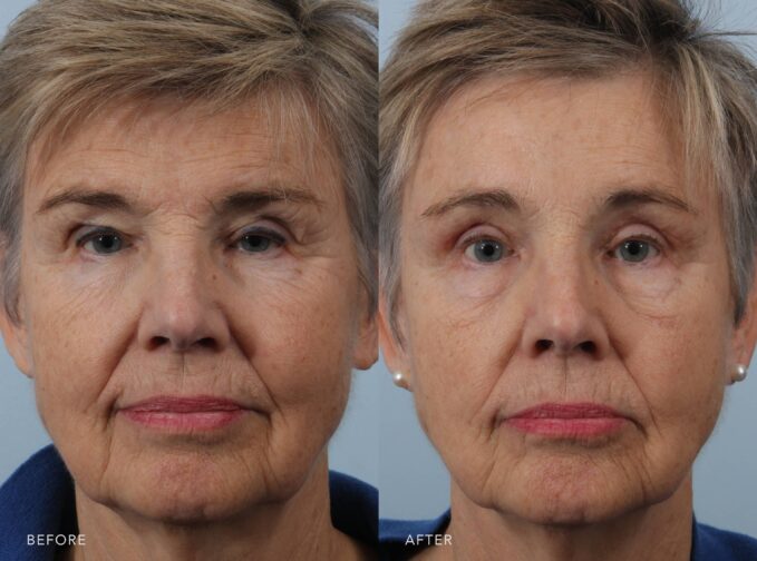 A photo of a woman's face before and after the brow lift with bilateral upper eyelid sliver blepharoplasty procedure. The before picture shows a small or more shadowed eye due to the weight of excess skin, leading to a hooded appearance of her upper eyelids. The after photo shows a more rested and rejuvenated eye, revealing a more defined and visible upper eyelid with her excess loose skin removed. | Albany, Latham, Saratoga NY, Plastic Surgery