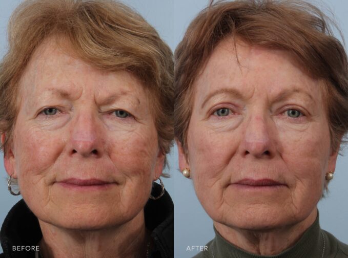 A photo of a woman's face before and after the Bilateral Upper Blepharoplasty and Bilateral Brow Lift procedure. Before photo shows a tired and aged appearance due to sagging skin on her eyelid, covering the upper eyelashes. The after photo shows a larger and brighter eye due to the reduction of hooding, making expressions look more awake and vibrant. | Albany, Latham, Saratoga NY, Plastic Surgery