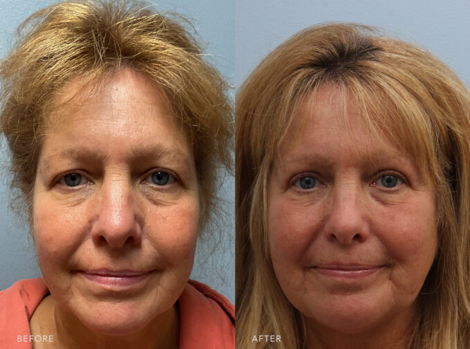 A photo of a woman's face before and after the Upper Blepharoplasty and Brow Lift procedure. Before photo shows droopy eyelids, casting shadows over her eyes and contributing to a darker or more tired look. The after photo shows smooth and firm eyelids without excess sagging or creases and her eyes that look naturally wider and more open. | Albany, Latham, Saratoga NY, Plastic Surgery