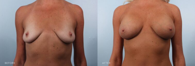 A photo of a woman's body before and after the Bilateral Breast Augmentation with Implants procedure. Before photo shows breasts that appear spaced widely with a noticeable gap in the middle. The after photo shows a firm and elevated breast appearance with a gentle slope or fullness in her upper pole, rather than sagging or flatness. | Albany, Latham, Saratoga NY, Plastic Surgery