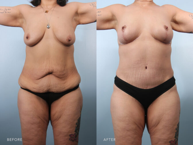 A photo of a woman's body before and after Abdominoplasty with Liposuction of Back Flanks and Abdomen procedure. Before photo shows a numerous folds and creases that formed irregular patterns across the surface, giving it an almost quilted texture and resembling a crumpled piece of paper. While the after photo shows a sleek and smooth appearance, resembling a finely polished surface, well-toned and creating a streamlined silhouette. | Albany, Latham, Saratoga NY, Plastic Surgery