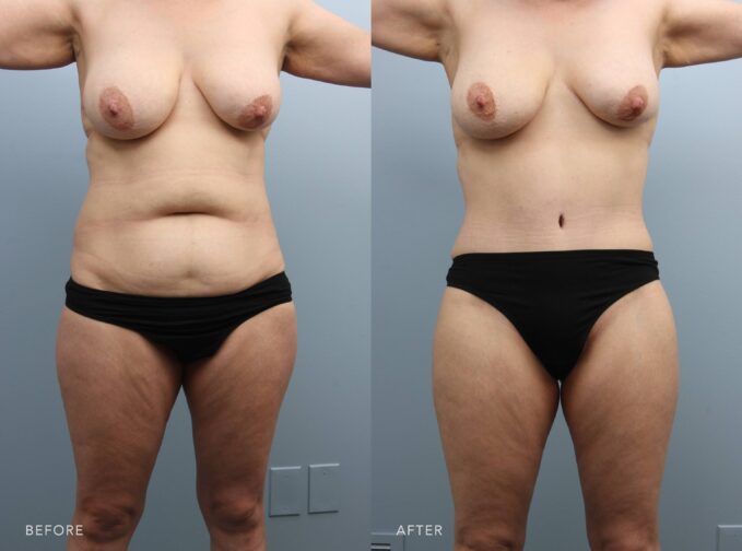 A photo of a woman's body shows before and after the Abdominoplasty procedure. Before photo shows stubborn fat in her abdominal area, particularly in the lower belly or around the waist, affecting the overall silhouette. The after photo shows a flat and toned abdomen with reduced bulging or protrusion, contributing to an overall improved silhouette. | Albany, Latham, Saratoga NY, Plastic Surgery