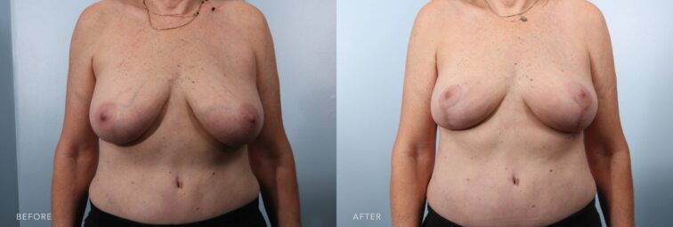 A photo of a woman's body before and after the Bilateral Breast Lift procedure. The before picture shows breasts sitting lower on the chest wall due to stretched ligaments and loss of skin elasticity. The after photo shows breasts repositioned higher on the chest wall, creating a more youthful and elevated appearance. | Albany, Latham, Saratoga NY, Plastic Surgery