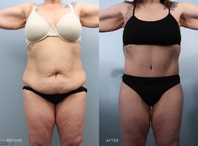 A photo of a woman's body before and after the Panniculectomy procedure. The before photo shows a disproportionate abdomen to the rest of her body due to the excess skin hanging over it. The after photo shows removed excess skin and fat in her lower abdomen, resulting in a flatter, smoother abdominal area. | Albany, Latham, Saratoga NY, Plastic Surgery