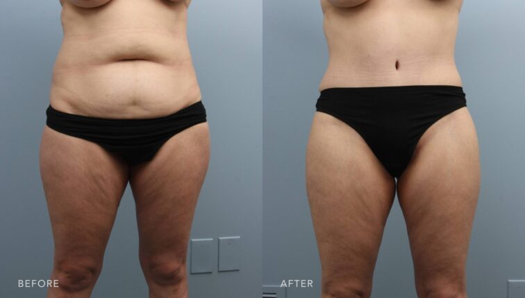 A photo of a woman's body shows before and after the Abdominoplasty procedure. Before photo shows stubborn fat in her abdominal area, particularly in the lower belly or around the waist, affecting the overall silhouette. The after photo shows a flat and toned abdomen with reduced bulging or protrusion, contributing to an overall improved silhouette. | Albany, Latham, Saratoga NY, Plastic Surgery