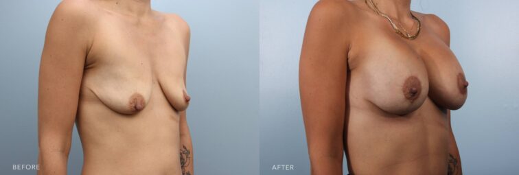 A side-by-side view of a woman's body before and after the Lift with Augmentation procedure. The before photo shows flattened or elongated breasts due to the breast volume that shifted to the lower part of her breasts, giving it a bottom-heavy look. The after photo shows an increased overall breast volume, resulting in a rounder, fuller contour. | Albany, Latham, Saratoga NY, Plastic Surgery