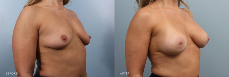 A photo of a woman's body before and after the Lift with Augmentation procedure. Before photo shows a wider breast base that spreads out horizontally, caused to appear further apart, especially when lying down, as the tissue moves outward. The after photo shows a forward projection, creating a visually pleasing balance between her breasts, waist, and hips and contributing to an hourglass figure. | Albany, Latham, Saratoga NY, Plastic Surgery