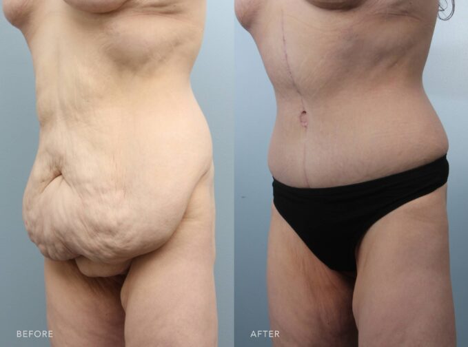 A side-by-side view of a woman's body before and after the Panniculectomy with fleur-de-lis abdominoplasty, liposuction of flanks, and abdomen procedure. Before photo shows uneven body contour with her excess fats and skin leading to irregular bulges and a lack of smooth transitions between her body areas. The after photo shows a more balanced body contour with the removed excess fats, creating a sleeker and more symmetrical appearance. | Albany, Latham, Saratoga NY, Plastic Surgery