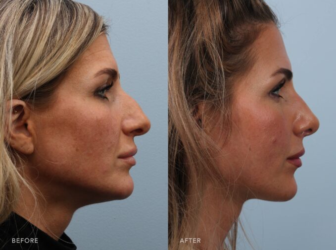 A side-by-side view of a woman's face before and after the Cosmetic Rhinoplasty procedure. Before photo shows low or lacks definition on the bridge of her nose, particularly in some ethnic nasal structures. The after photo shows an improved nasal bridge height, creating