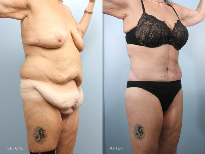 A side-by-side view of a woman's body before and after Fleur De Lis Abdominoplasty procedure. Before photo shows a downward displacement or drooping of skin and tissue across multiple planes of her body, resulting to a significant excess skin. While the after photo shows restoration of a more youthful and vibrant appearance through the removal of excess skin and tissue and the refinement of her body contours. | Albany, Latham, Saratoga NY, Plastic Surgery