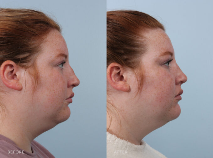 A side-by-side view of a woman's face before and after the Cosmetic Rhinoplasty procedure. Before photo shows a noticeable bump on the bridge of her nose, giving her nose a curved or uneven appearance in profile view. The after photo shows improved nasal symmetry, resulting in a more symmetrical and even appearance from both the front and side views. | Albany, Latham, Saratoga NY, Plastic Surgery