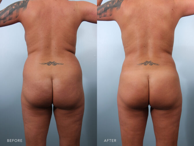 A photo of a woman's body before and after the Liposuction of the Flanks and Abdomen procedure. Before photo exhibits a diminished volume, resulting in a sunken and a hollowed-out appearance of her buttocks. While the after photo shows a firm and muscular appearance and a well-proportioned buttocks, contributing to her overall shapely physique. | Albany, Latham, Saratoga NY, Plastic Surgery