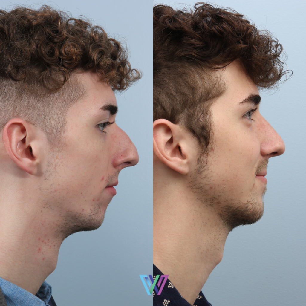 Rhinoplasty Before and after