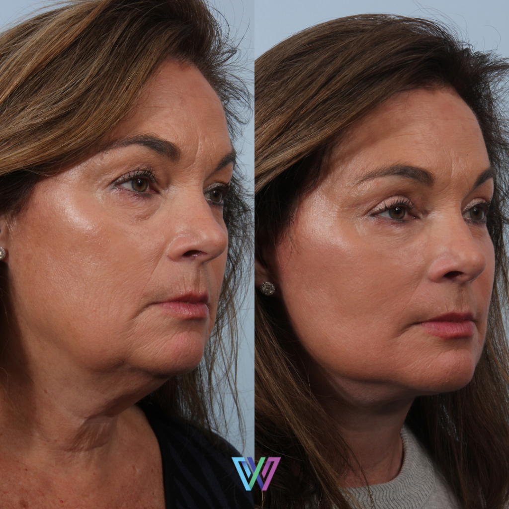 Facelift: Woman in 50's