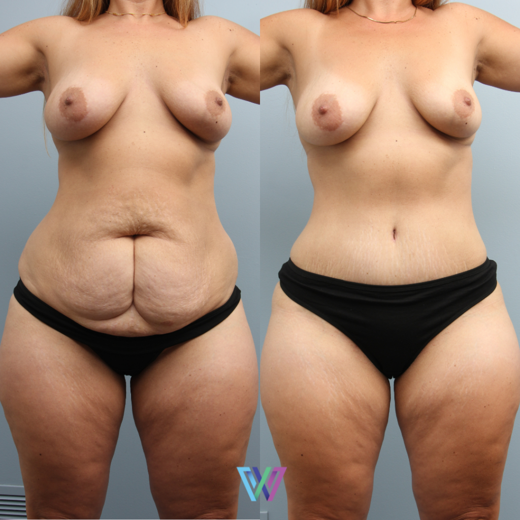 Tummy tuck before and after